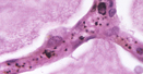 Image of Kaposi's Sarcoma in an AIDS patient.