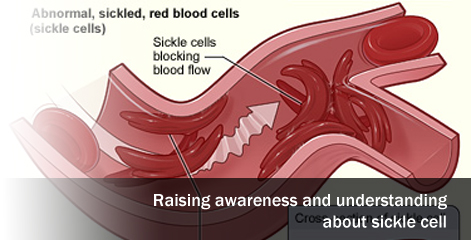 Raising awareness and understanding about sickle cell