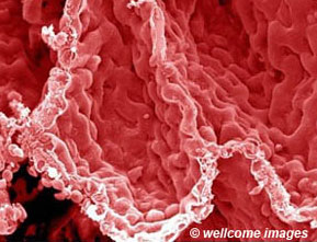 Scientific photograph of lung suffering with pulmonary fibrosis disease.