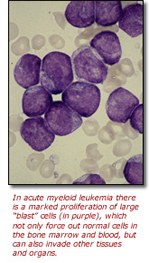 Image of Leukemia Blast Cells