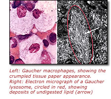 Left: Gaucher macrophages, showing the crumpled tissue paper appearance. Right: Electron micrograph of a Gaucher lysosome, circled in red, showing deposits of undigested lipid (arrow)