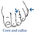 Drawing of a foot with arrows pointing to a corn and a callus.