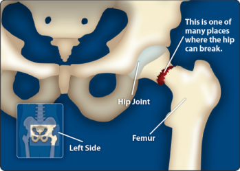 graphic of broken hip.