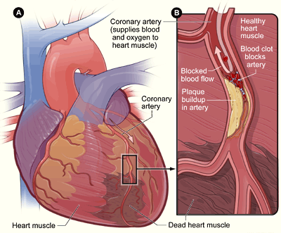 Figure A shows a heart with dead heart muscle caused by a heart attack. Figure B is a cross-section of a coronary artery with plaque buildup and a blood clot.  