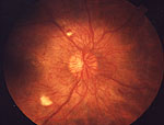 Eye with diabetic retinopathy