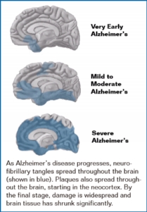 3 brains showing shrinkage and spread of disease, from mild to severe