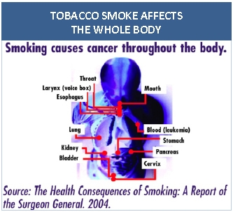 Tobacco smoke effects the whole body. Diagram shows the damage of smoking throughout the body.