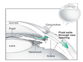 Conventional surgery.