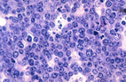 Burkitt lymphoma cells stained purple