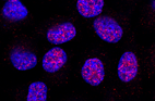 Microscopic view of prostate cancer cells, stained purple and red, with red showing where Schlafen-11 is located in the nucleus 