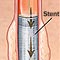 Illustration of esophageal stent 
