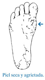 Ilustración de la planta de un pie con una flecha que señala hacia la piel seca y agrietada