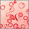 Glóbulos rojos: falciformes y cuerpos de Pappenheimer