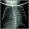 Retorno venoso pulmonar total anómalo, rayos X