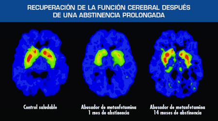 Imagen que muestra la recuperación de la función cerebral después de la abstinencia prolongada