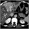 Liver with disproportional fattening, CT scan