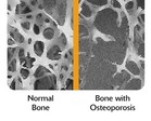 Healthy and Damaged Bone - Click to enlarge in new window.