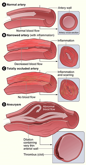 Figure A shows a normal artery with normal blood flow. The inset image shows a cross-section of the normal artery. Figure B shows an inflamed, narrowed artery with decreased blood flow. The inset image shows a cross-section of the inflamed artery. Figure C shows an inflamed, blocked (occluded) artery and scarring on the artery wall. The inset image shows a cross-section of the blocked artery. Figure D shows an artery with an aneurysm. The inset image shows a cross-section of the artery with an aneurysm.