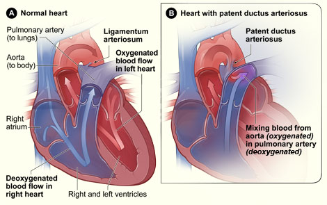 Figure A shows a cross-section of a normal heart. The arrows show the direction of blood flow through the heart. Figure B shows a heart with patent ductus arteriosus. The defect connects the aorta and the pulmonary artery. This allows oxygen-rich blood from the aorta to mix with oxygen-poor blood in the pulmonary artery.