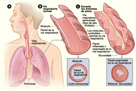 La figura A muestra la ubicación de los pulmones y las vías respiratorias en el cuerpo. La figura B muestra un corte transversal de una vía respiratoria normal. La figura C muestra un corte transversal de una vía respiratoria durante los síntomas de asma. 