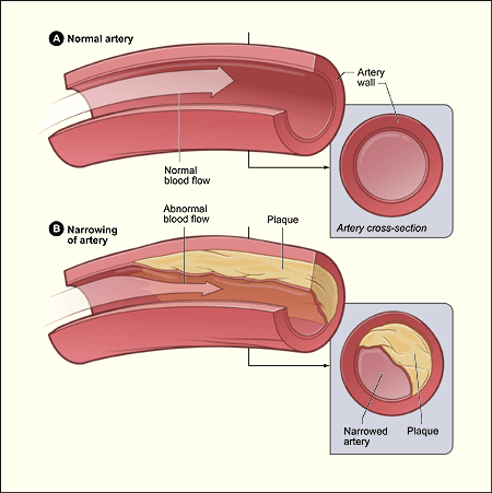 Figure A shows a normal artery with normal blood flow. The inset image shows a cross-section of a normal artery. Figure B shows an artery with plaque buildup. The inset image shows a cross-section of an artery with plaque buildup.   