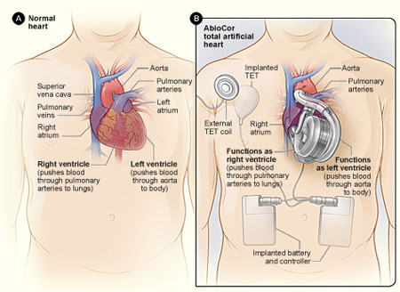 Figure A shows the normal structure and location of the heart. Figure B shows an AbioCor TAH and the internal devices that control how it works. 