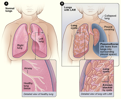 Figure A shows the location of the lungs and airways in the body. The inset image shows a cross-section of a healthy lung. Figure B shows a view of the lungs with LAM and a collapsed lung (pneumothorax). The inset image shows a cross-section of a lung with LAM.
