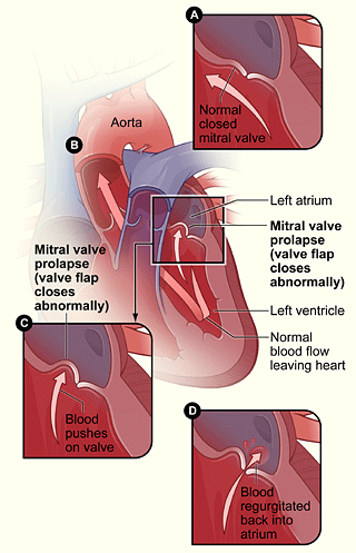 Figure A shows a normal mitral valve. The valve separates the left atrium from the left ventricle. Figure B shows a heart with mitral valve prolapse. Figure C shows a closeup view of mitral valve prolapse. Figure D shows a mitral valve that allows blood to flow back into the left atrium.