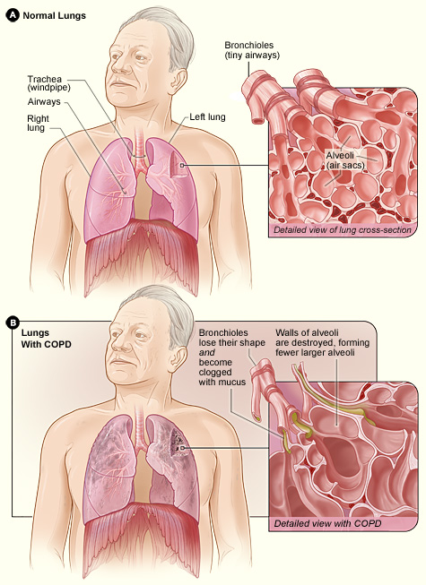 Figure A shows the location of the lungs and airways in the body. The inset image shows a detailed cross-section of the bronchioles and alveoli. Figure B shows lungs damaged by COPD. The inset image shows a detailed cross-section of the damaged bronchioles and alveolar walls.