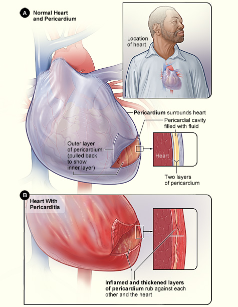 Figure A shows the location of the heart and a normal heart and pericardium (the sac surrounding the heart). The inset image is an enlarged cross-section of the pericardium that shows its two layers of tissue and the fluid between the layers. Figure B shows the heart with pericarditis. The inset image is an enlarged cross-section that shows the inflamed and thickened layers of the pericardium. 