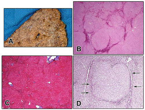 (A) Gross photograph of a resected specimen showing NRH. The liver parenchyma is diffusely transformed into nodules approximately 1 mm in size. (B) Low magnification examination shows vague nodularity on routine staining, here enhanced by congestion in areas of atrophy between the nodules (hematoxylin-eosin; original magnification ×4). (C) Staining for collagen with a Masson trichrome shows that there is no significant fibrosis present. (D) Nodules with expanded liver cell plates surrounded by zones of reticulin compression (arrows), where the liver cells are small, atrophic, and pressed together.