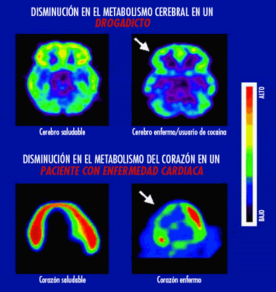 Disminución en el metabolismo cerebral drogadicto. Disminución en el metabolismo del corazón en un paciente con enfermedad cardiaca.