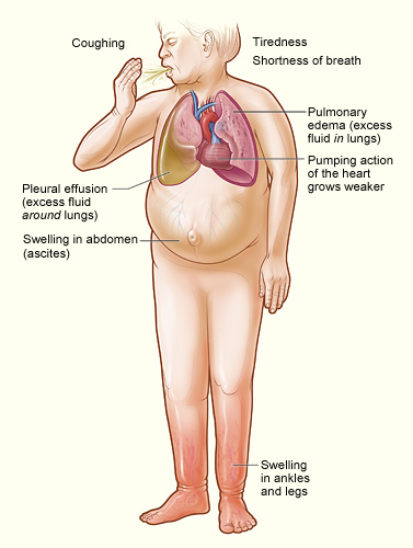 The image shows the major signs and symptoms of heart failure.