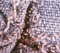 Body lice eggs in the seams of a piece of clothing