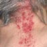shingles rash on the back of a neck
