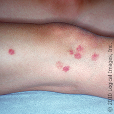 A photograph of a leg with bedbug bites