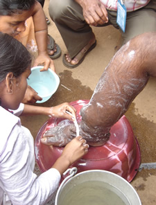 A community volunteer shows how to properly wash and dry the legs of a person with lymphedema.  This is a critical hygiene component that helps prevent further local infection.