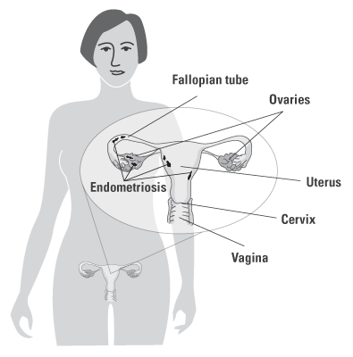 female reproductive system including fallopian tube, ovaries, uterus, cervix, vagina and endometriosis