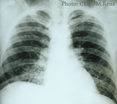 An x-ray of lungs with acute pulmonary histoplasmosis