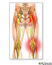 Ilustración de daño al nervio ciático