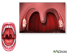 Illustration of the mouth showing symptoms of strep throat