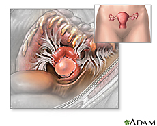 Illustration of an ovarian cyst