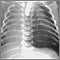 Neumotórax, radiografía de tórax