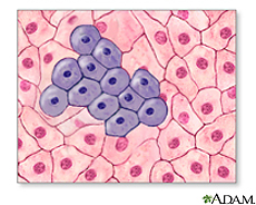 Ilustración de células cancerosas