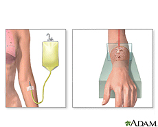 Ilustración de radioterapia intravenosa y por máquina de radiación
