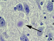 Micrografía de células cerebrales con un cuerpo de Lewy presente en la esfera morada suave al centro del imagen