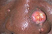 Foto de cáncer de piel que tiene el aspecto de un bulto sólido y rojizo.