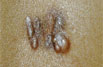 Foto de cáncer de piel que se ve como una cicatriz gruesa e irregular.