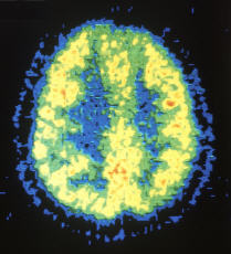 Diapositiva color de una tomografía por emisión de positrones (PET) de un cerebro normal