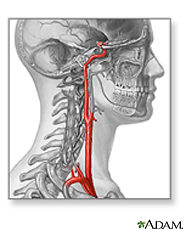 Ilustración de la arteria carótida